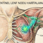 Sentinel Lenf Nodu Haritalaması | Jinekolog Onkolog Doç. Dr. Sema Karakaş